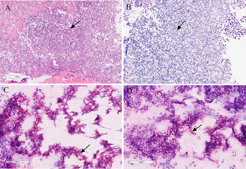 Figure 4 The histopathology of the mediastinal specimen obtained from the mediastinal mass. Hematoxylin & eosin (H&E) staining showed many neutrophil cell infiltration and Aspergillus hyphae, along with the hyphae with regular septation and branching at a acute angle (black arrows). (A) H&E staining of ultrasound-guided mediastinal mass puncture tissue; (B) H&E staining of EBUS-TBNA tissue; (C and D) Histiocyte smear of EBUS-TBNA tissue.