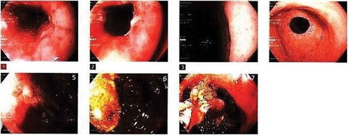 Figure 2. Initial EGD: 1,2 - Reveal LA Grade D esophagitis. 6,7 - Reveal large malignant ulcerated mass with stigmata of bleeding in secondpart of duodenum. 7- Reveal image of forceps lifting the stone in Duodenal lumen.