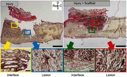 Figure 10 Histological examination images of the injury sites at 30 days post-injury by HvG staining. Spinal cords orientation indicated by the set of arrows: Ro – Rostral, C – Caudal, D – Dorsal, and V – Ventral.Notes: Reprinted from López-Dolado E, González-Mayorga A, Gutiérrez MC, Serrano MC. Immunomodulatory and angiogenic responses induced by graphene oxide scaffolds in chronic spinal hemisected rats. Biomaterials. 2016;99:72–81. Copyright 2016, with permission from Elsevier.Citation208