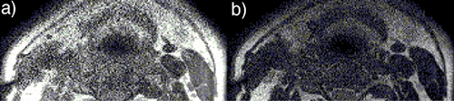 Figure 2. Influence of improper coil placement on image quality is depicted by (a) T1, and (b) T2 weighted BB images of the carotids. (View this art in color at www.dekker.com.)