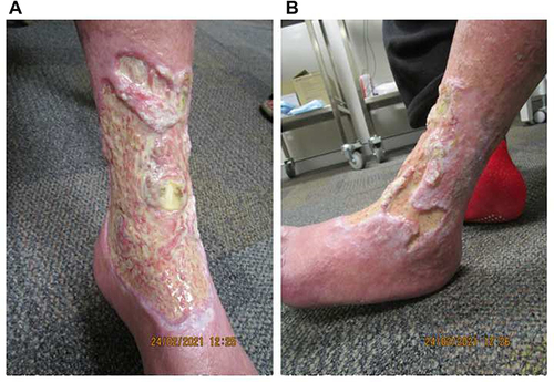 Figure 4 The underlying dermis at week 28 of tildrakizumab treatment, following judicious debridement on the (A) anteromedial and (B) anterolateral aspects of the left leg. The extensor digitorum longus tendon, previously obscured by thick fibrin, is exposed, flanked by prominent dermal proliferation.