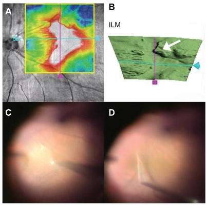 Figure 2 The right eye of a 75-year-old patient with idiopathic epiretinal membrane. A) Retinal map image obtained by optical coherence tomography (OCT) shows the range of epiretinal membrane. B) Three dimensional retinal map images obtained by OCT. The arrow shows the membrane that was elevated from the internal limiting membrane (ILM). C, D) Intraoperative photographs. C) 25-gauge micro-hooked needle was used to elevate the epiretinal membrane from the retinal surface. Because the membrane was elevated from the ILM (arrow) as shown by OCT (B) it was easy to pick up the edge of the membrane. D) One-piece membrane was removed by 25-gauge micro-hooked needle.