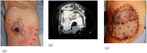 Figure 3. Recurrent lesion on the right knee. (a) The lesion on the right knee: obvious nodule with purpura and skin necrosis is marked. Arrows indicate the inflammation spreading around the knee. (b) Computed tomography images showing calcification and inflammation at the knee joint. (c) The skin graft was applied as a sheet in the knee joint area.