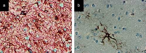 Figure 2.  Immunohistochemical stainings with antibodies for the astrocytic marker GFAP (glial fibrillary acidic protein) of the peri-tumoural cortices of two different samples of diffuse astrocytomas (WHO grade II). a) A significant increase of reactive astrocytes is demonstrated in the peri-tumoural cortex of this patient with chronic epileptic seizures, compared tob) the peri-tumoural cortex of a patient who did not have any epileptic seizures.