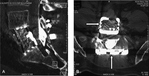 Figure 4. A. sagittal CT reconstruction depicting solid bony fusion through the cage and physiological alignment. B. Axial CT showing the cage filled with bone (horizontal arrow) and the posterior implants (vertical arrow) 6 months after surgery.