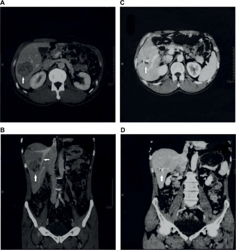 Figure 8 Transversal and coronal CT planes of patient #1 who presented with large (>5 cm) and small (<3 cm) lesions and an AFP level of 428.7 IU/mL in December 2010 (A and B on the left). As patient was not eligible for resection due to proximity to portal vein, he consented to receive daily pill of V5. On the next visit, 4 months later, his AFP level dropped to 2.5 IU/mL at which time point lesions were cleared (C and D). Patient’s health improved remarkably; he gained weight, went back to work, and has remained in complete remission since then.