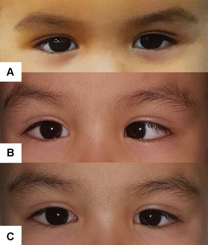 Figure 3 Example case 2 of AACE: (A) photo prior to onset, (B) photo of deviation prior to treatment and (C) photo after surgical intervention.