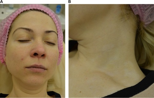 Figure 7 Patient L, the macules of vitiligo on the face (A) and the neck (B) 2 weeks after the treatment with NCTF135.