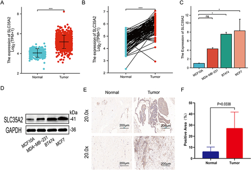 Figure 7 Verification of SLC35A2 expression in breast cancer. SLC35A2 expression in breast cancer and unmatched (A) /matched (B) normal tissues in TCGA and GTEx databases. (C) Relative mRNA expression of SLC35A2 in breast cancer cell lines. (D) Expression of SLC35A2 protein in breast cancer cell lines. (E and F) Immunohistochemical analysis of SLC35A2 in breast cancer. (*p < 0.05, ***p < 0.001).