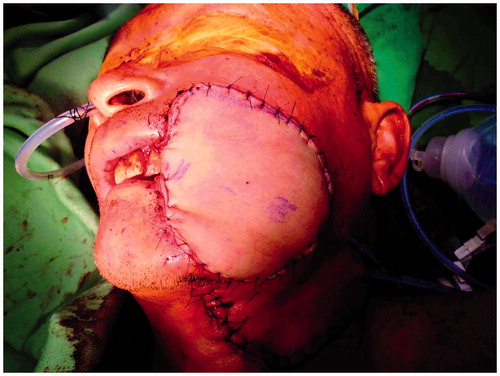 Figure 5. Immediate post-operative view of Case 2 following reconstruction with an ALT-free flap.