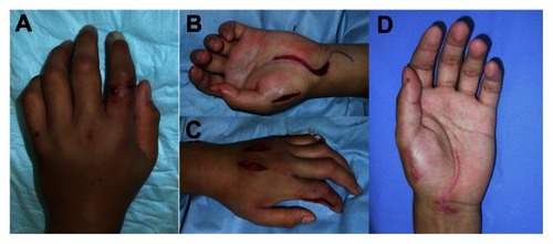 Figure 2 A 20-year-old man with a bite to the proximal dorsum of the left index (A). Relaxation incision was performed on both sides of the index, the dorsal hand and the distal portion of the flexor retinaculum (B and C). Three months after injury, he had no sequelae in his hand (D).