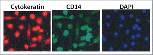 Figure 5. CTCs enriched from a CRC patient undergoing metastasectomy with a simple centrifugation technique (OncoQuick®) were cultured directly. Further staining revealed large CTCs that were pan-cytokeratin+ (left image), DAPI+ (right image) and also expressed macrophage marker CD14 (middle image) in addition to leucocyte marker CD45 (not shown). We hypothesize that CTCs capable to spread and replicate in other organs induce immune tolerance by fusing with tumor-associated macrophages.
