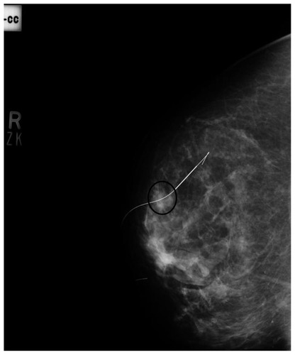 Figure 1 True Lateral View of mammogram right breast showing Kopan’s 20G 9cm needle localizing a soft tissue nodule (Black circle).