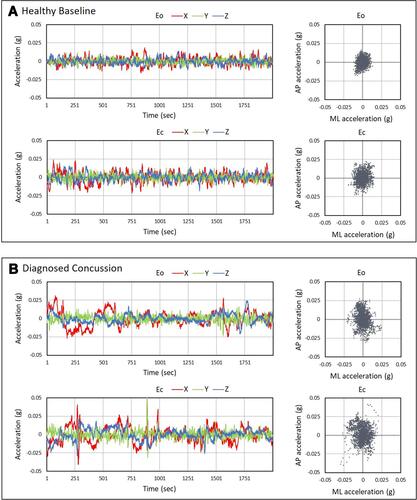 Figure 2 Sample eyes open (Eo) and eyes closed (Ec) x(anterior-posterior, AP), y(vertical), z(medial-lateral, ML) acceleration time series data and AP/ML acceleration spatial scatter plots for age/gender-matched (A) healthy baseline participant (B) patient with diagnosed concussion.