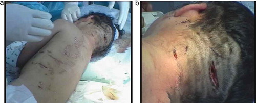 Figure 1. (a) Multiple wounds on the patient’s head and back (photographed before suturing).(b) Deep and large wounds on the patient’s head (photographed before suturing).