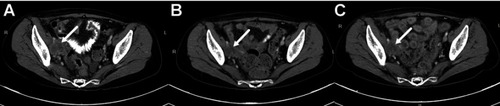 Figure 2 The CT scan of the cervical cancer patient.