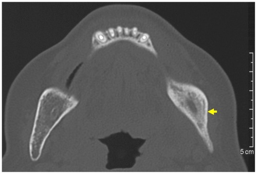 Figure 2 Plain computed tomography at first visit revealed increased density of cancellous bone.