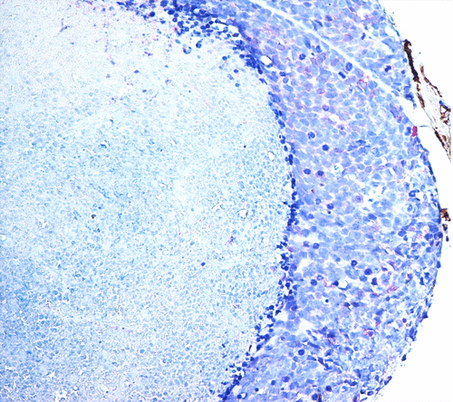 Figure 3. Interplay between COX-2 over-expression in phlogistic cells and CD-34 positive endothelial cell at invasive front of OSCCs. Photo 2a, COX-2 expressing phlogistic cells captured in deep invasion of OSCC contribute to neoplastic neoangiogenesis inducing CD34 positive endothelial cells (LSAB-HRP, nuclear counterstaining with hematoxylin; original magnification x200). Photo 2b Higher magnification of micro- and macro vessels CD34 positive and COX-2 positive inflammatory cells (LSAB-HRP, nuclear counterstaining with hematoxylin; original magnification x400).