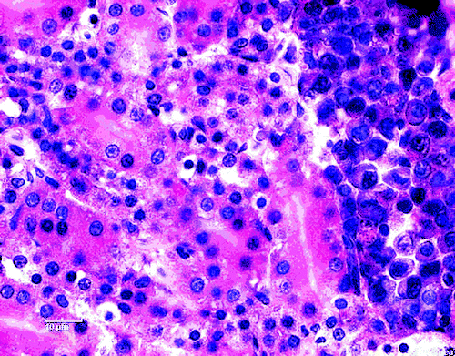 Figure 4.  Focal mononuclear cell hyperplasia (plasma cells) in the kidney. H & E stain (scale bar= 10 µm).