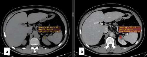 Figure 1 Clear Cell Renal Cell Carcinoma. 47-year-old male. (a) Non-contrast axial CT scan, with a mass in the upper pole of the Lt Kidney. Mean HU=16.15. (b) Post-contrast nephrogenic phase axial CT scan with the mass in the upper pole of the Lt Kidney. Mean HU= 63.74.