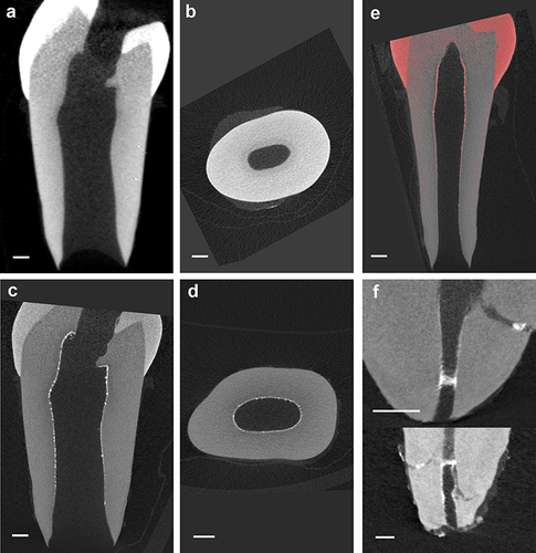 Figure 4 Micro-CT images of root canals treated with EDTA during root canal preparation are presented in (a and b), displaying the longitudinal and cross-sectional sections, respectively. (c and d) show the corresponding images of remineralized root canals. The high-density range of micro-CT images (gray values distributed above 7000) is highlighted in red (e). The density of the remineralized crystal deposit layer on the inner wall of the root canal was higher than natural root canal. (f) High-density mineral deposits can also be observed in the lateral root canals of the teeth. Scale bar: 1 mm.
