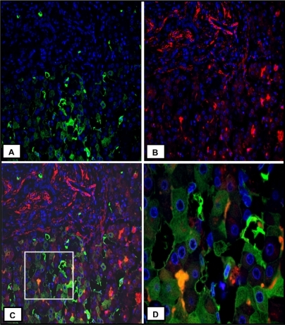 Figure 4 Characterization of hepatic cellular sources of TGFβ1 in human BA. A) Immunofluorescence staining for TGFβ1 (green, original magnification ×20). B) Immunofluorescence staining for α-SMA (red, original magnification ×20). C) Merge image of A and B. D) The original magnification ×60 of the box in C. Heterogeneous expression of TGFβ1 is seen in hepatocytes.