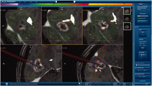 Figure 1. Display interface of the NeuroBlade System during ablation of deep-seated occipital brain metastases. Using this interface it is possible to assess the extent of ablation in three axial levels perpendicular to the laser probe (upper panels). On the bottom panels, it is possible to observe the sagittal and coronal planes, parallel to the probe. Note use of DTI-tractography (in white) to generate the optic radiations.