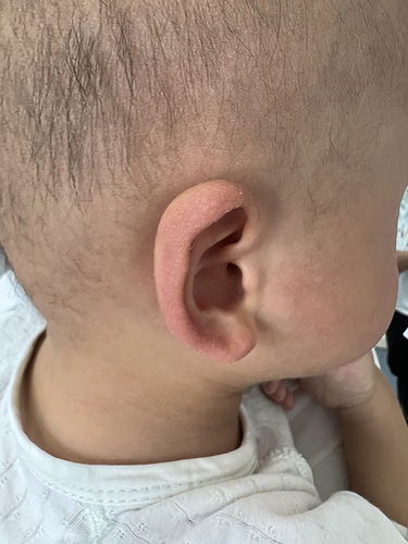 Figure 3 Skin of the auricles and the front of the ears observed in the child.