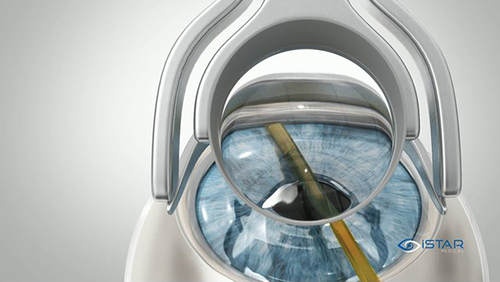 Figure 4 Schematic showing the flexible sheath gently being advanced in between the scleral spur and the ciliary body while visualizing the angle with a gonioprism. © iSTAR Medical.