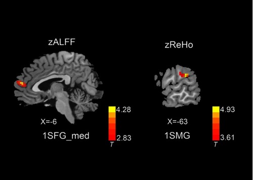 Figure 2 zALFF and zReHo differences between the two groups (P<0.01, cluster-wise FDR corrected). Red-yellow spots, CSM>HC.