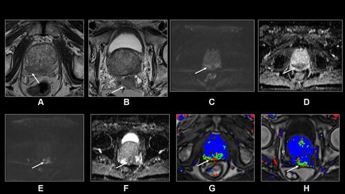 Figure 3 TTransverse T2-weighted TSE (A and B), DWI and ADC (C-F), and T1-weighted primary perfusion map (G and H) demonstrate a large infiltrative PIRADS 5 tumor arising from the peripheral zone invading the transitional zone and extending outside the prostate gland and into the seminal vesicles. The tumor is a Gleason 4+4 tumor with associated extracapsular extension (arrow, A) and seminal vesicle invasion (arrow, B). The tumor is very dark on T2 with associated diffusion restriction and increased perfusion.