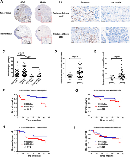 Figure 1 CD66b+ neutrophils were predominantly located within the peritumoral stroma region in LSCC patients, which were associated with poorer prognosis. (A) Representative images were shown for CD45 and CD66b IHC staining of tumor tissues and normal tissues from LSCC patients. (B) Representative LSCC tumor tissues exhibited various density of CD66b+ neutrophils in peritumoral stroma and intratumoral regions. Bars = 50μm. (C) Infiltrating CD66b+ neutrophils in intratumoral and peritumoral region of tumor tissue, and epithelium and sub-epithelium region of normal tissues were analyzed. (D and E) LSCC patients with advanced T stage had more intratumoral and peritumoral infiltrated CD66b+ neutrophils. (F–I) Kaplan–Meier curves for overall survival and disease-free survival of 45 LSCC patients according to different density of CD66b+ neutrophils infiltrated in peritumoral stroma and intratumoral regions of tumor tissues. 50X, 200X, 400X: magnification of 50, 200, and 400 fold; *p < 0.05, **p < 0.01, ***p < 0.001.