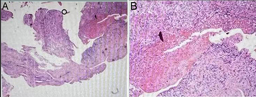 Figure 8 (A and B) H&E staining of C6–7 disc space tissues shows acute and chronic inflammatory cell infiltration and granulation tissue formation.