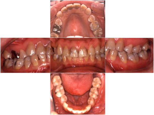 Figure 7. Intraoral photos taken at the 7-year follow-up. No substantial wear was noted on the resin-only restorations.