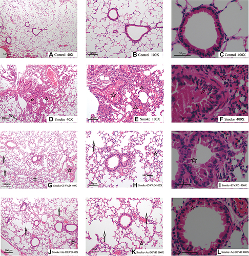 Figure 2 Representative photomicrographs of hematoxylin and eosin staining of lung sections (original magnification × 40, 100, and 400). (⇧) Arrowheads represent pulmonary emphysema. (☆) represent exudates. (∆) represent inflammatory cell infiltration. (◊) represent epithelial proliferation. Control group (A-C) normal lung tissues. Smoke group (D-F) inflammation and pulmonary emphysema. Z-VAD group (G-I) reduced inflammation and emphysema than the smoke group. Ac-DEVD group (J-L) reduced inflammation than the smoke group.