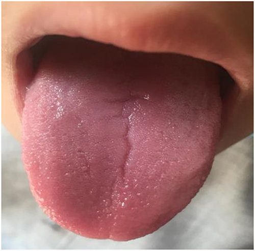 Figure 4 Single and superficial fissure.