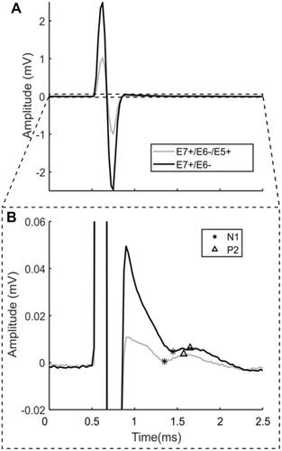 Figure 6 Stimulation using 90 μs pulse widths at 6.6 mA delivered to both E7+/E6− and E7+/E6−/E5+ in clinical Subject #4 with recording on E1/E0. (A) Extent of entire artifact shows that peak-to-peak artifacts are decreased from 5.7 mV with bipolar stimulation to 2.2 mV with tripolar stimulation. (B) The plot in A is zoomed in to best appreciate the residual artifact and ECAP, which is approximately 8–10 μV in amplitude.