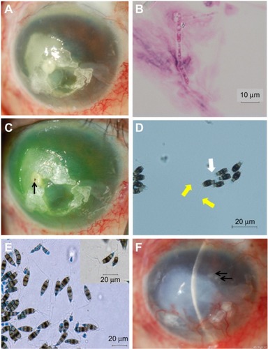 Figure 2 Slit-lamp and light microscopy photographs.