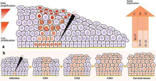 Figure 1. Life cycle of high-risk Human Papillomavirus (hrHPV) in cervical epithelia and the progression from infection to cervical cancer. 1A) First, hrHPV enters through a microwound to the basal membrane of the cervical epithelia, where the infected cells are maintained as a reservoir. The expression of E1 and E2 proteins drives the initial viral amplification in the lower layers of the epithelia. When these cells divide, the expression of E6 and E7 proteins stimulates cell proliferation (orange cells with a light orange nucleus) to the mid-layers of the epithelia. In the mid-layers, the expression of E4 with the help of E1, E2, and E5 facilitates higher viral DNA amplification (orange cells with an enlarged and irregular nucleus, known as koilocytotic cells). Finally, the cells leave the cell cycle (E4+) and express L1 and L2 proteins, allowing the packaging of the amplified virus (orange cells with a dark orange nucleus) and the subsequent release. Gene expression of viral proteins (right arrow), viral DNA amplification, and cell proliferation (left arrows) start from low levels (light orange) at the basal layers and go to high levels (dark orange) at the mid or upper layers of the cervical epithelia in hrHPV-infected women. 1B) After an hrHPV infection, the virus induces cell proliferation, and the infected tissue can progress to CIN. The first lesions, low-grade intraepithelial lesions (LSIL, CIN1), might regress after one year. However, they can also progress to high-grade intraepithelial lesions (HSIL, CIN2 – CIN3) and then to cervical cancer. CIN: cervical intraepithelial neoplasia