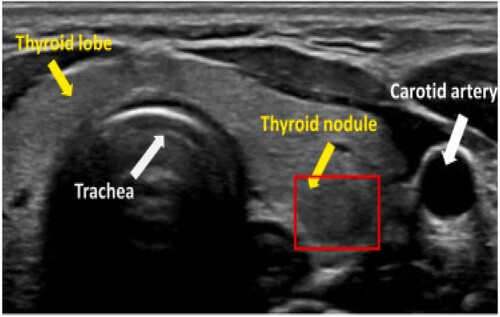Figure 1. Ultrasound image with thyroid nodule and thyrolobe.