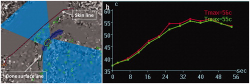 Figure 3. (a) The thermal evaluation screen displaying the results of the last performed sonication. The operator can confirm the results of individual sonication sessions after each sonication or after a series of the treatments. Note the successful previous sonication area is mapped in the dark blue. (b) Temperature elevation is monitored by two curves indicated mean (green) and maximum (red) temperature at the area of the cross cursor in the left screen.