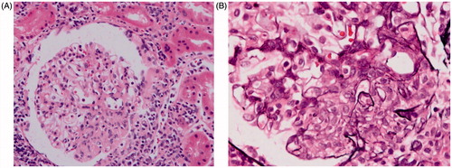 Figure 1. (A) H&E stain (×200) showing increased mesangial hypercellularity in a glomerulus. (B) Silver stain (×400) showing segmental proliferative lesions in a glomerulus.