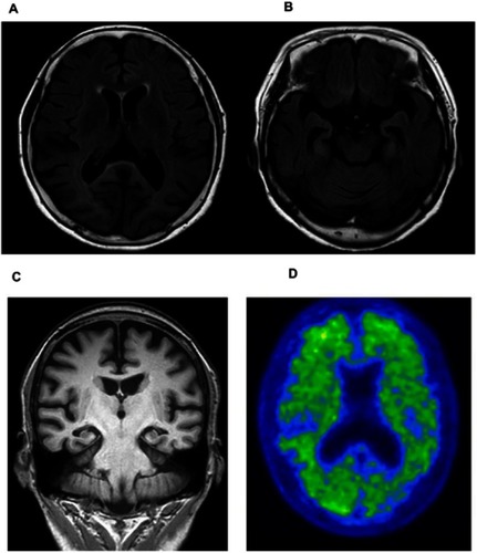 Figure 2 (A) Axial FLAIR image of the patient shows moderate atrophy in the bilateral cortices and (B) moderate atrophy in the hippocampus. (C) Coronal MRI image of patient. (D) Axial 18F-fluorbetaben positron emission tomography of the patient shows increased diffusion uptake over the bilateral cortices.