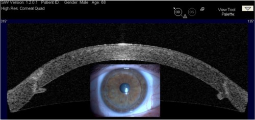 Figure 7 A 68-year-old male patient had penetrating keratoplasty in his right eye 8 years earlier.