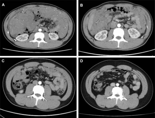 Figure 2 Whole abdomen CT images show abdominal mass prior to treatment (A), after 2 cycles of treatment (B), after 4 cycles of treatment (C), and after the whole treatment (8 cycles) (D).