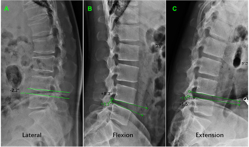 Figure 4 Method of measuring ISA (A) and sROM (B and C) using the superior and inferior endplate of L4 –L5 on the lateral view. (A) positive ISA was defined by ventrally located angular intersection of lumbar spine, and a negative angle was defined by dorsally located angular intersection. The ISA was −2.2° in a case of recurrent LDH (L4-5). (B and C) The sagittal range of motion (sROM) of L4 –L5 was defined as the absolute value of extension (B) – flexion (C) angles. The sROM at L4-5 was 9.8° in another patient.