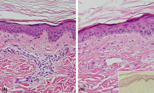 Figure 1. (A) The biopsy specimen from atrophic scar lesion (B) Biopsy from erythematous patch (H&E, X200, inlet: fontana silver stain).