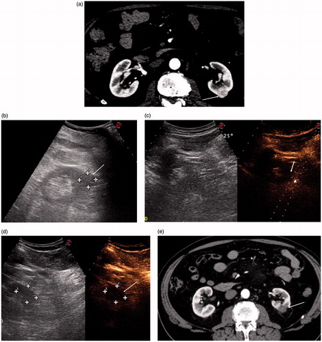 Figure 4. (a) CT scan showing an exophytic hyperenhancing nodule in the middle third of the left kidney (arrow). (b) US scan showing the same nodule (arrow). (c) Post-procedural CEUS scan showing residual enhancing tissue (arrowhead) in the inferolateral margin of the ablation zone (arrow). The residual viable tissue is targeted for immediate retreatment under CEUS guidance (dotted lines). (d) CEUS scan performed after the retreatment showing disappearance of the residual enhancing tissue (arrow). (e) CECT scan performed 1 month after LA showing complete disappearance of enhancement of the nodule with fibrosis of the surrounding fat (arrow).