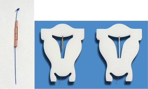 Figure 6 GyneFix 200 (Contrel Europe, Belgium), real size (left), in situ in foam uterus (middle), compared with the frameless FibroPlant-LNG (Contrel Europe, Belgium), which is derived from the frameless copper-releasing intrauterine device (IUD) (right).