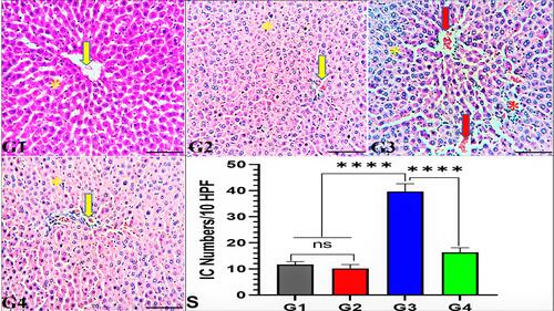 Figure 1 Effect of garlic extract on trastuzumab induced hepatotoxicity in rats. Liver sections from G1 (control group) and G2 (garlic-treated group) show normal hepatic architecture of hepatocytes (yellow star) with normal central vein (yellow arrow). Additionally, G3 (trastuzumab-treated group) reveals hydropic changes of hepatocytes (yellow star) with focal inflammatory cells (ICs) infiltration (red star) and congested central veins (red arrow). In contrast, G4 (trastuzumab+garlic-treated group) exhibits normal features of hepatic architecture, nearly similar to G1. H&E, 200x, bar =100 µm. (S) Quantitative analysis of the ICs/10 fields (HPF). nsNo significance between G1 vs G2, ****Significance difference G1, G2 vs G3, and G3 vs G4 (p<0.001).